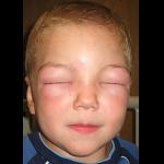 Profilbild von Anaphylaxie