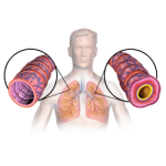 Profilbild von asthma